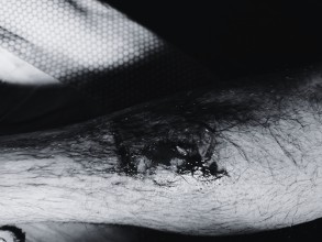 कुकुरको टोकाइबाट खानेपानी मिटर रिडर घाइते