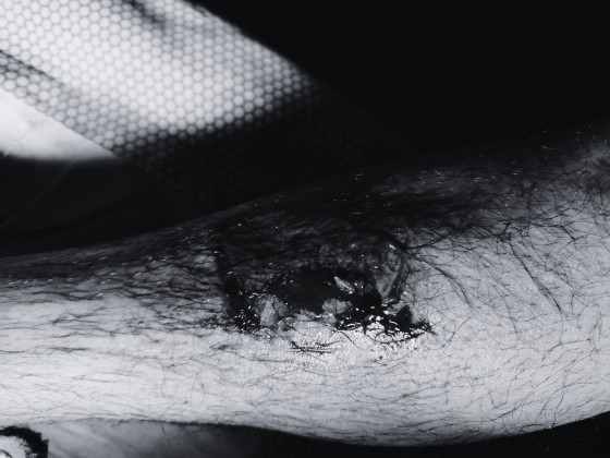 कुकुरको टोकाइबाट खानेपानी मिटर रिडर घाइते