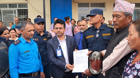 चिकित्सकको लापरबाही : शल्यक्रिया गरिएकी सुत्केरीको पेटभित्र गज भेटियो