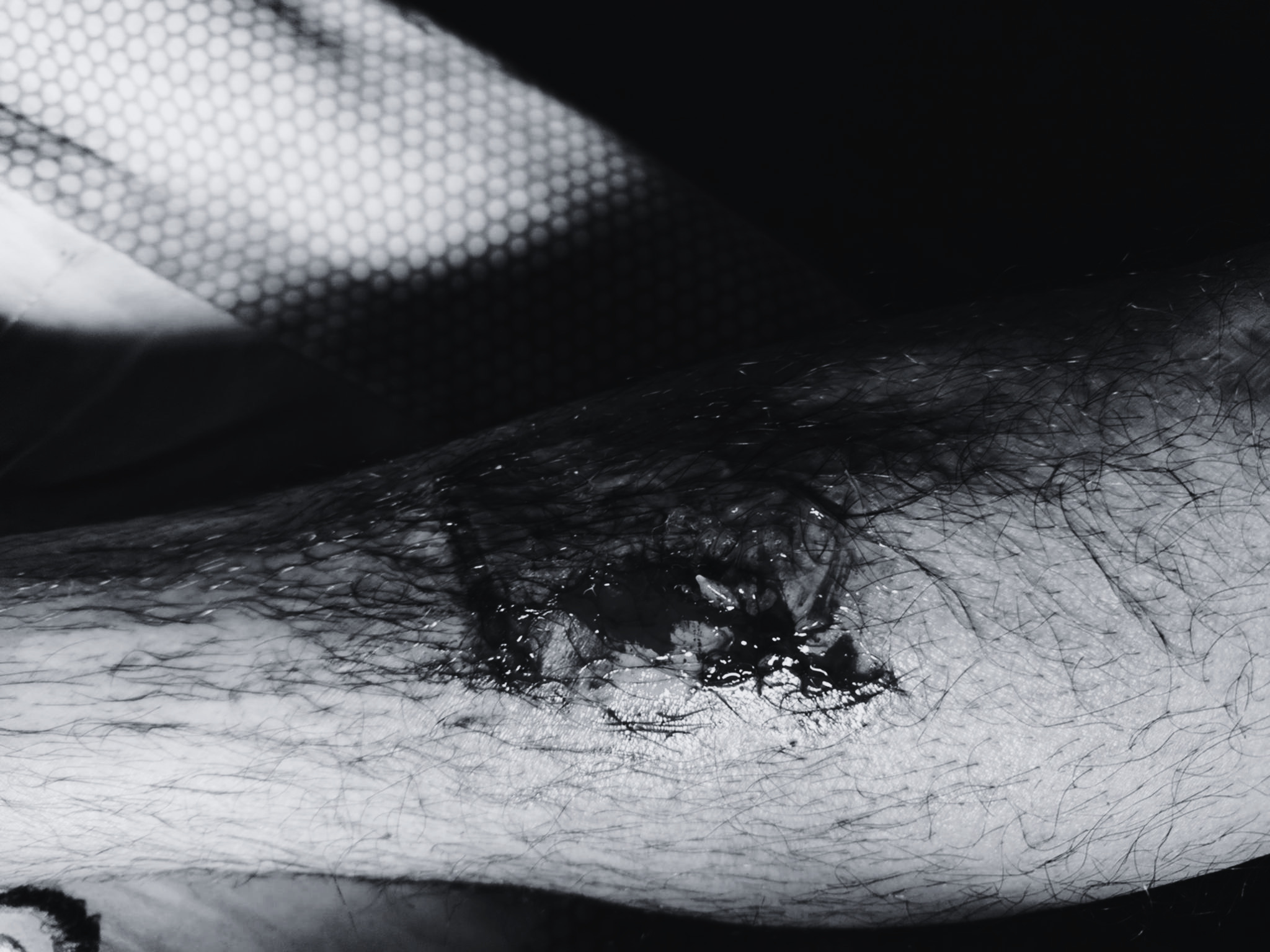 कुकुरको टोकाइबाट खानेपानी मिटर रिडर घाइते